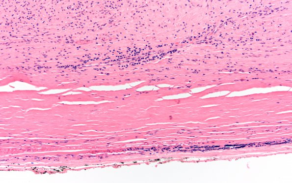 3A3 Schwannoma, cellular (Case 3) H&E 20X