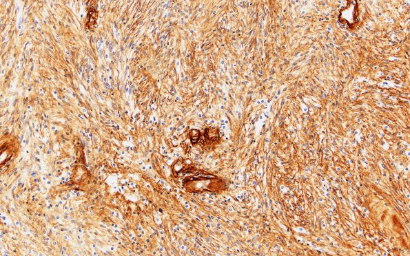 3C1 Schwannoma, cellular (Case 3) Coll IV 20X