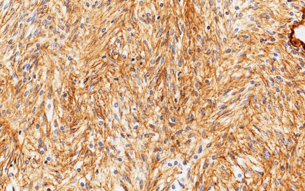 3C2 Schwannoma, cellular (Case 3) Coll IV 40X