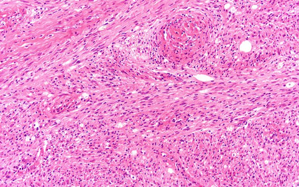 4A2 (Schwannoma, cellular (Case 4) H&E 20X 3