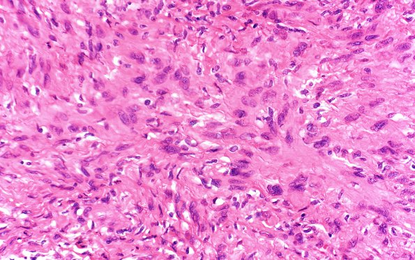 4A3 (Schwannoma, cellular (Case 4) H&E 40X 2