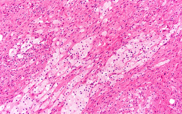 4A4 (Schwannoma, cellular (Case 4) H&E 20X