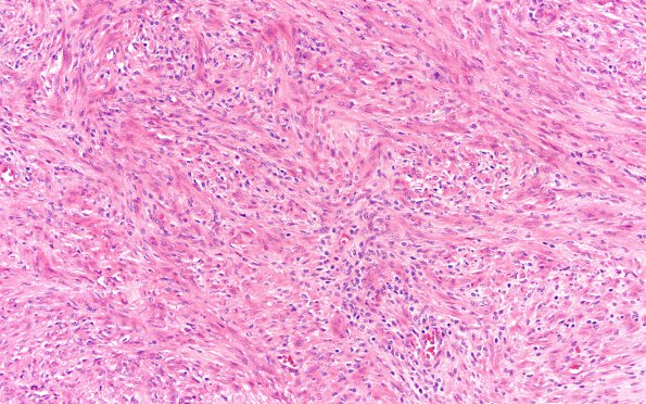 5A2 Schwannoma, cellular (Case 5) H&E 20X 2