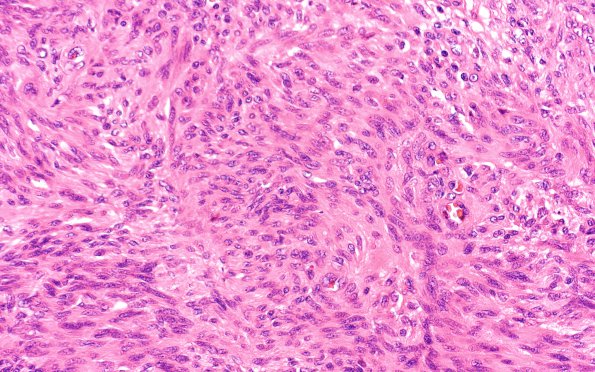 5A3 Schwannoma, cellular (Case 5) H&E 40X