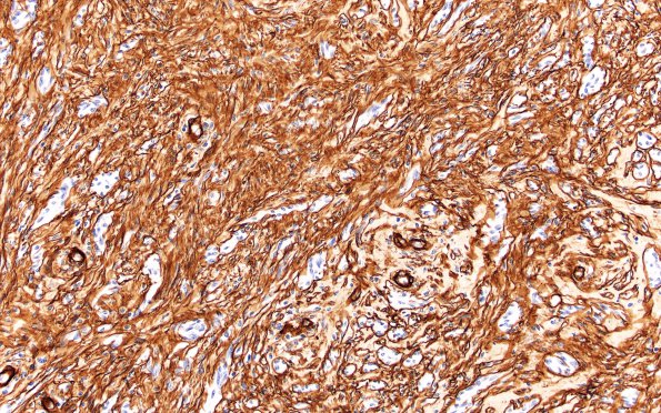 5C2 Cellular Schwannoma (Case 5) Coll IV 20X 2