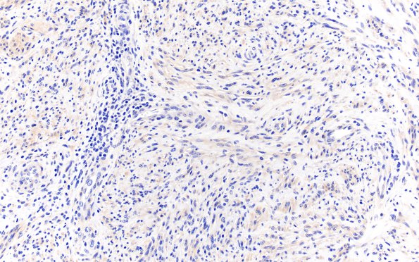 5D Schwannoma, cellular (Case 5) EMA 20X 1