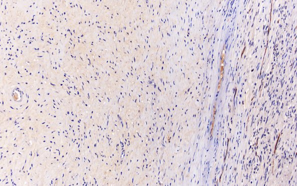 5E Schwannoma, cellular (Case 5) NF 20X 1