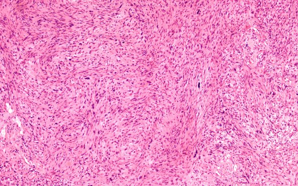 6A1 Schwannoma, cellular (Case 6) H&E 40X 2