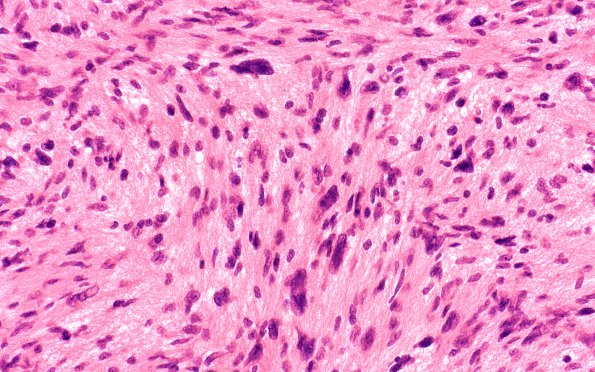 6A2 Schwannoma, cellular (Case 6) H&E 40X 1