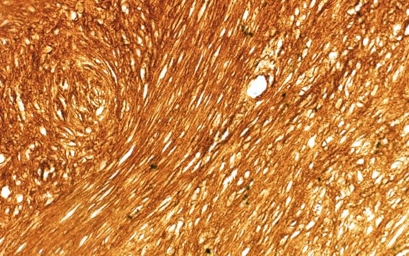 6C Schwannoma, cellular (Case 6) Coll IV 40X