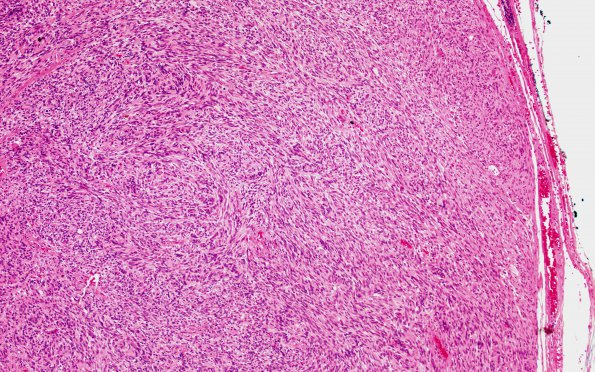 7A1 Schwannoma, cellular (Case 7) H&E 10X 1