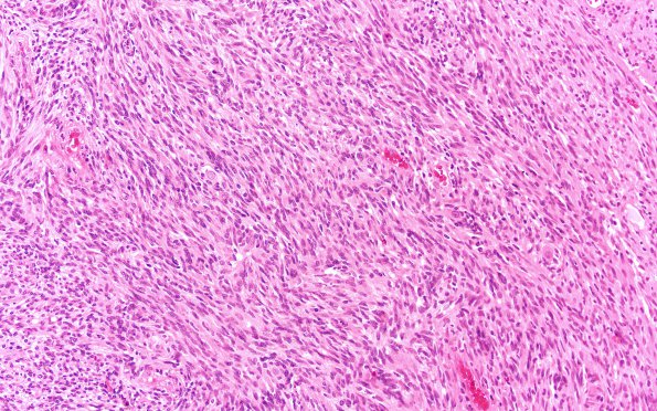 7A2 Schwannoma, cellular (Case 7) H&E 20X 1