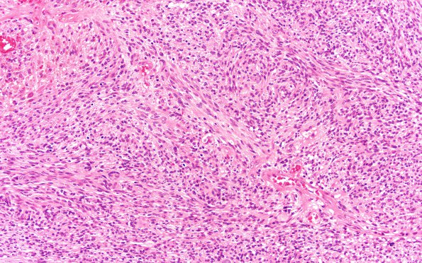 7A3 Schwannoma, cellular (Case 7) H&E 20X 3