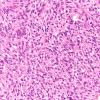 7A4 Schwannoma, cellular (Case 7) H&E 40X 1