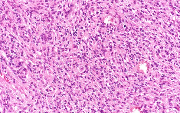 7A4 Schwannoma, cellular (Case 7) H&E 40X 1