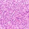 7A5 Schwannoma, cellular (Case 7) H&E 40X 2