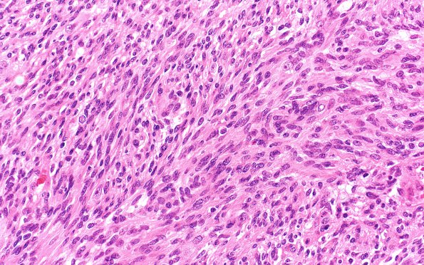 7A5 Schwannoma, cellular (Case 7) H&E 40X 2