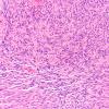 8A1 Schwannoma, cellular (Case 8) H&E 20X 4