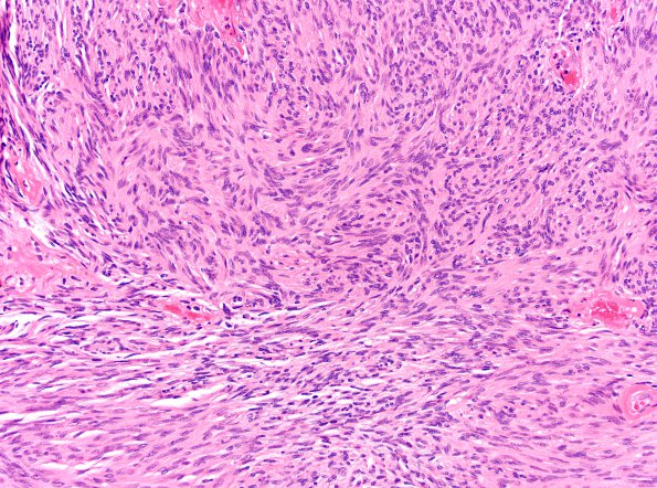 8A1 Schwannoma, cellular (Case 8) H&E 20X 4