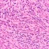 8A2 Schwannoma, cellular (Case 8) 40X