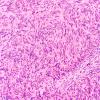 8A3 Schwannoma, cellular (Case 8) H&E 20X 2