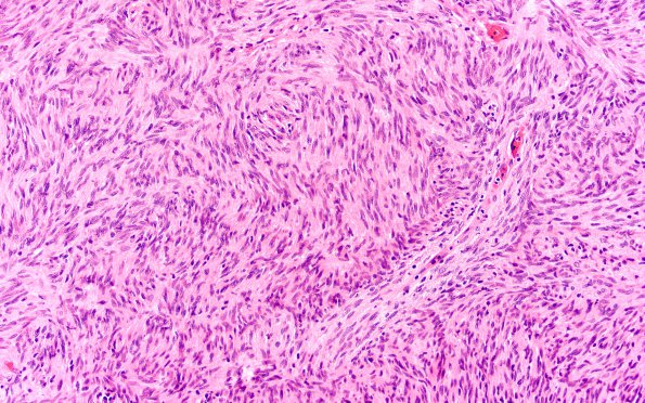 8A3 Schwannoma, cellular (Case 8) H&E 20X 2