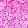 9A1 Schwannoma, cellular (Case 9) H&E 20X 2