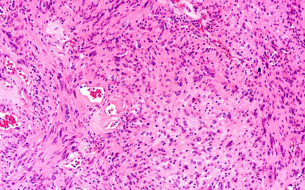 9A1 Schwannoma, cellular (Case 9) H&E 20X 2