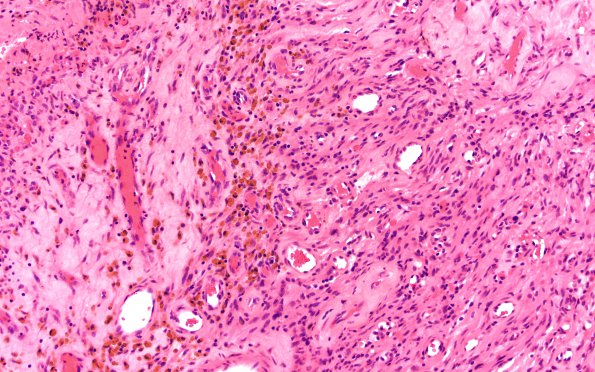 9A2 Schwannoma, cellular (Case 9) H&E 20X 1