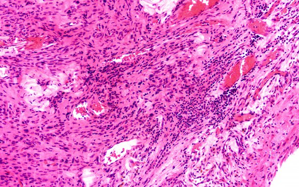 9A3 Schwannoma, cellular (Case 9) H&E 20X 3