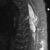 1A Schwannoma, plexiform, NF2 patient (Case 1, not sampled area) STIR - Copy