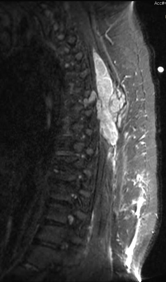 1A Schwannoma, plexiform, NF2 patient (Case 1, not sampled area) STIR - Copy