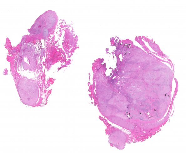 1B1 Schwannoma, plexiform, NF2 patient (Case 1) 1 H&E WM