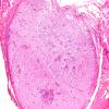 1B2 Schwannoma, plexiform, NF2 patient (Case 1) H&E 11