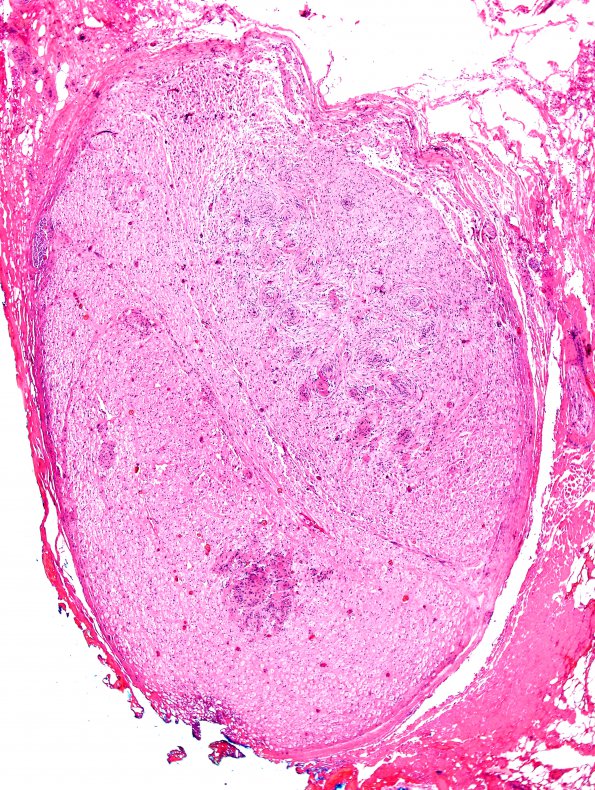 1B2 Schwannoma, plexiform, NF2 patient (Case 1) H&E 11