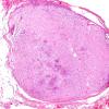 1B3 Schwannoma, plexiform, NF2 patient (Case 1) H&E 8