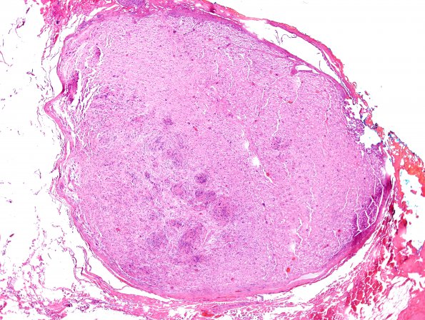 1B3 Schwannoma, plexiform, NF2 patient (Case 1) H&E 8