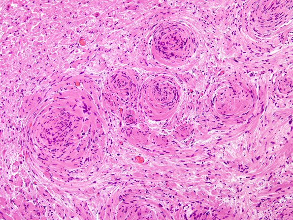 1B6 Schwannoma, plexiform, NF2 patient (Case 1) H&E 3