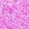 1B7 Schwannoma, plexiform, NF2 patient (Case 1) H&E 5