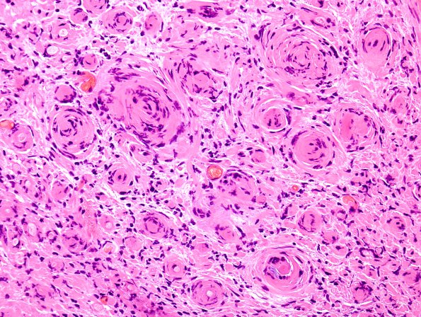 1B7 Schwannoma, plexiform, NF2 patient (Case 1) H&E 5