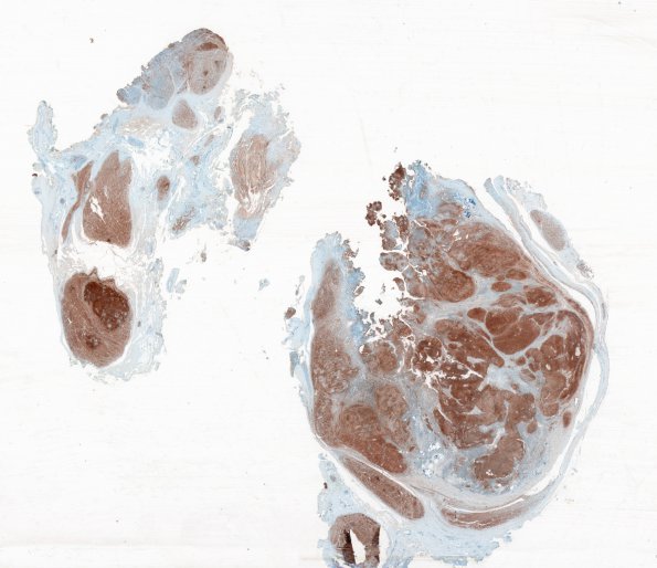 1C1 Schwannoma, plexiform, NF2 patient (Case 1) 1 S100 WM