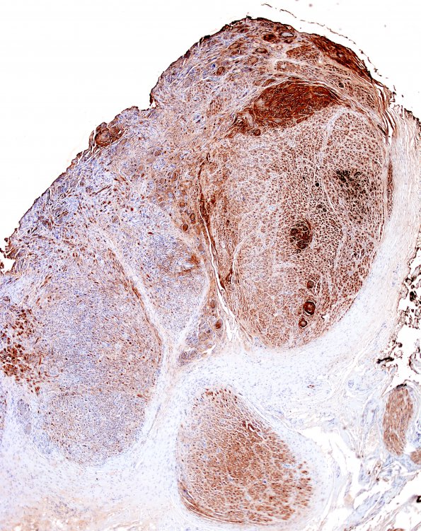 1C2 Schwannoma, plexiform, NF2 patient (Case 1) S100 5