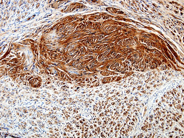 1C3 Schwannoma, plexiform, NF2 patient (Case 1) S100 1