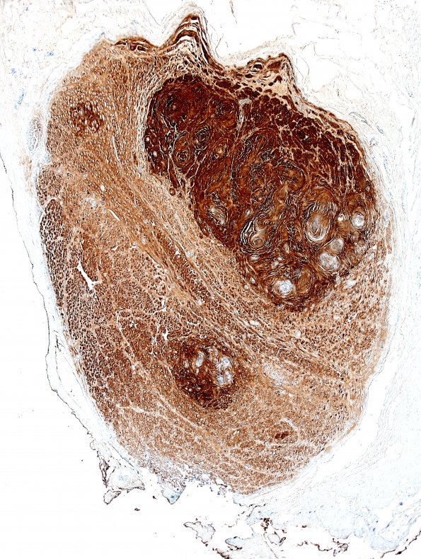 1C4 Schwannoma, plexiform, NF2 patient (Case 1) S100 6