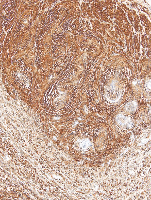 1C5 Schwannoma, plexiform, NF2 patient (Case 1) S100 7