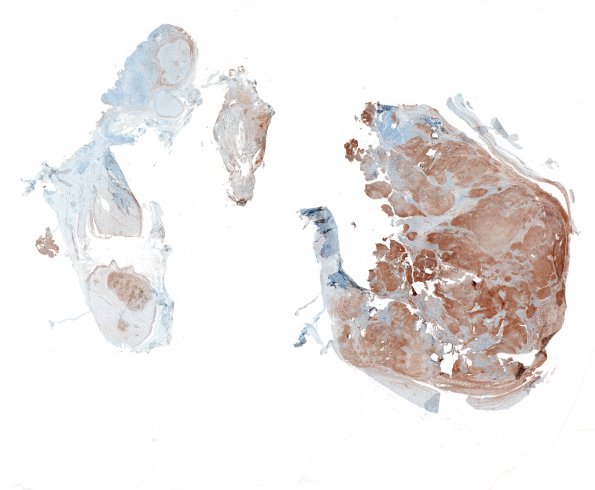 1D1 Schwannoma, plexiform, NF2 patient (Case 1) 1 Coll IV WM