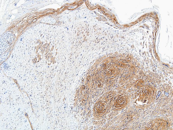 1D3 Schwannoma, plexiform, NF2 patient (Case 1) Coll 1V 8