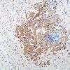 1D5 Schwannoma, plexiform, NF2 patient (Case 1) Coll 1V 1