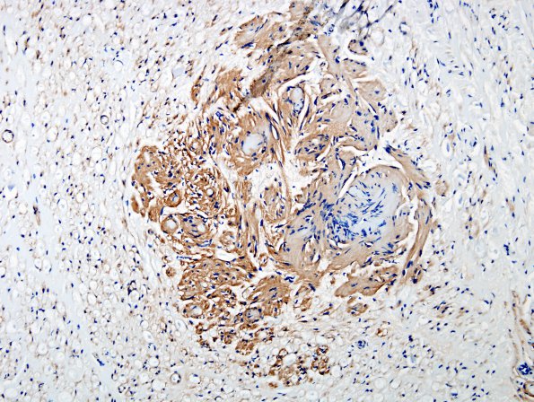 1D5 Schwannoma, plexiform, NF2 patient (Case 1) Coll 1V 1