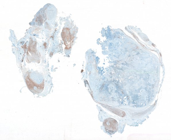 1E1 Schwannoma, plexiform, NF2 patient (Case 1) NF 10 relabeled